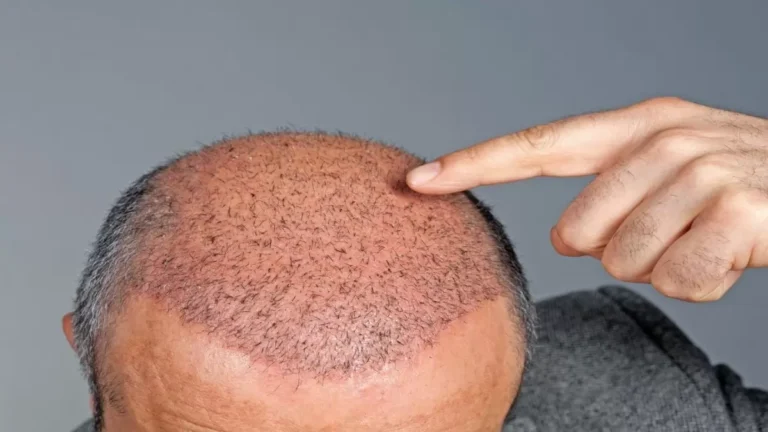 Hair Transplant Clinic