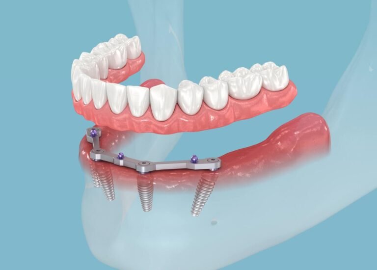 Teeth Replacement